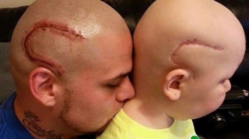 Để cho con mình không bị mặc cảm bởi vết sẹo sau khi mổ não, cha của cậu đã cạo tóc và xăm một hình vết sẹo y hệt trên đầu mình.