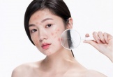 Mụn trứng cá gây thâm rỗ mặt: Bác sĩ da liễu mách cách chăm sóc da tốt nhất