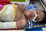 Người đàn ông nghèo bị bỏng nặng, không tiền điều trị