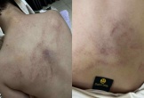 Tạm đình chỉ giáo viên mầm non bạo hành bé gái