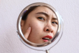 Hậu quả không thể cứu vãn từ thói quen nặn mụn